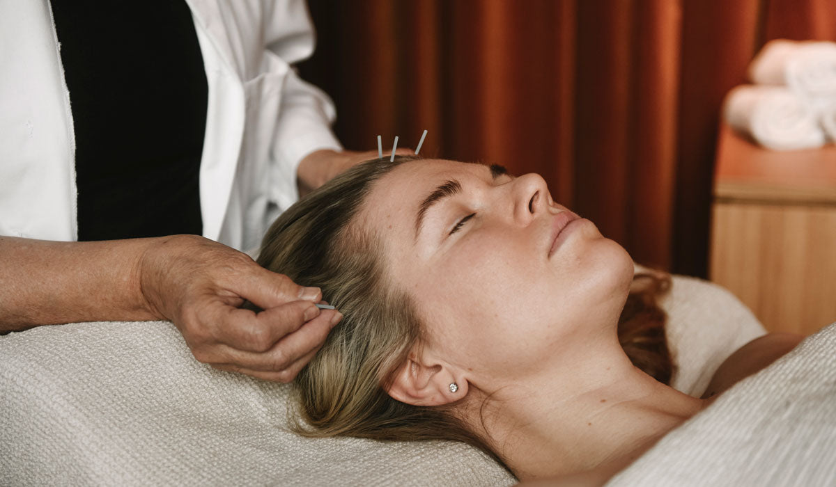 Acupuncture in Niki Newd® treatment — holistic technique to support skin health and inner balance.