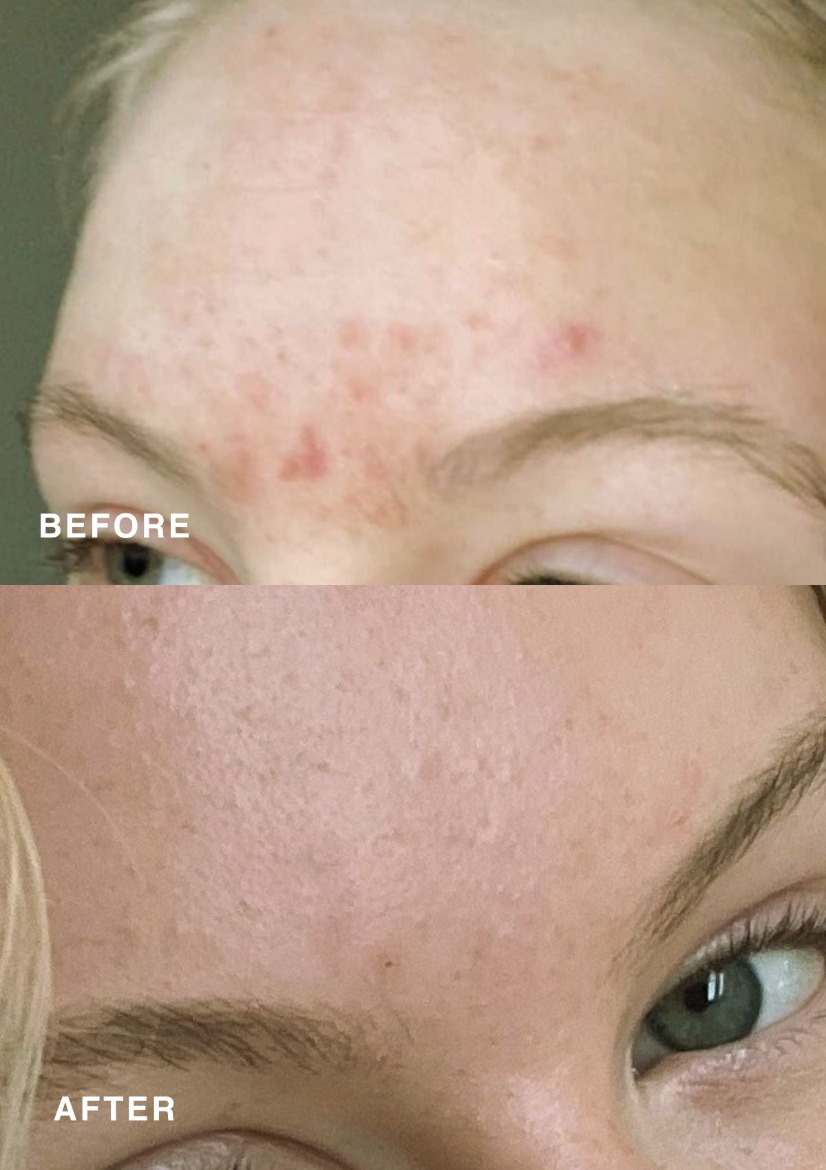 Before and after comparison showing a person’s face – acne on the left, smooth and clear skin on the right.